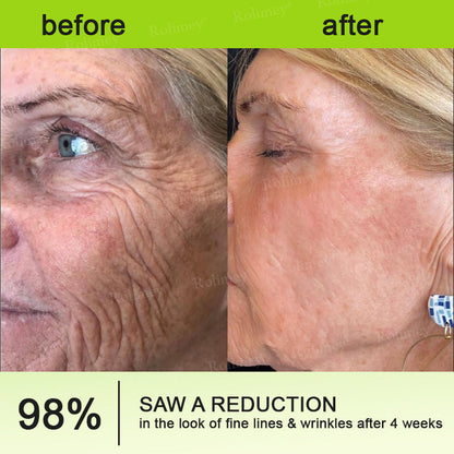 🧠👨‍⚕️Made and shipped from the USA 💫NATRAVOR® Botox & Vita-A Retinol Shot Wrinkle-Lift Tightening cream - Last Day Promotion 70% OFF